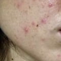 What Alcohol Does to Your Face: The Effects of Drinking on Skin Health